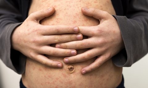 Alarm epidemiologiczny – osoba z odrą na lotnisku i w sklepach w Niles